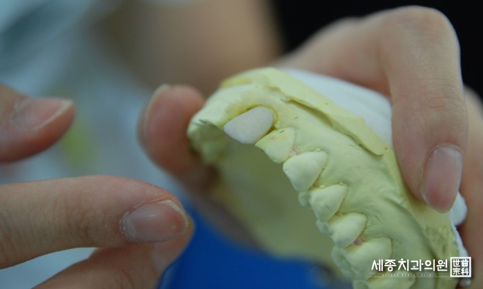 임시치아4.jpg