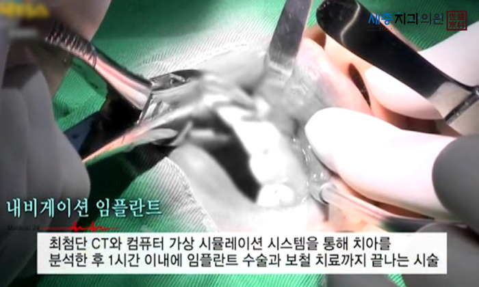 앞니5.jpg