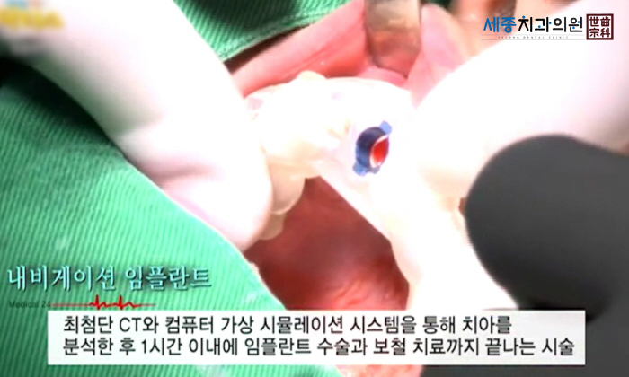 앞니7.jpg